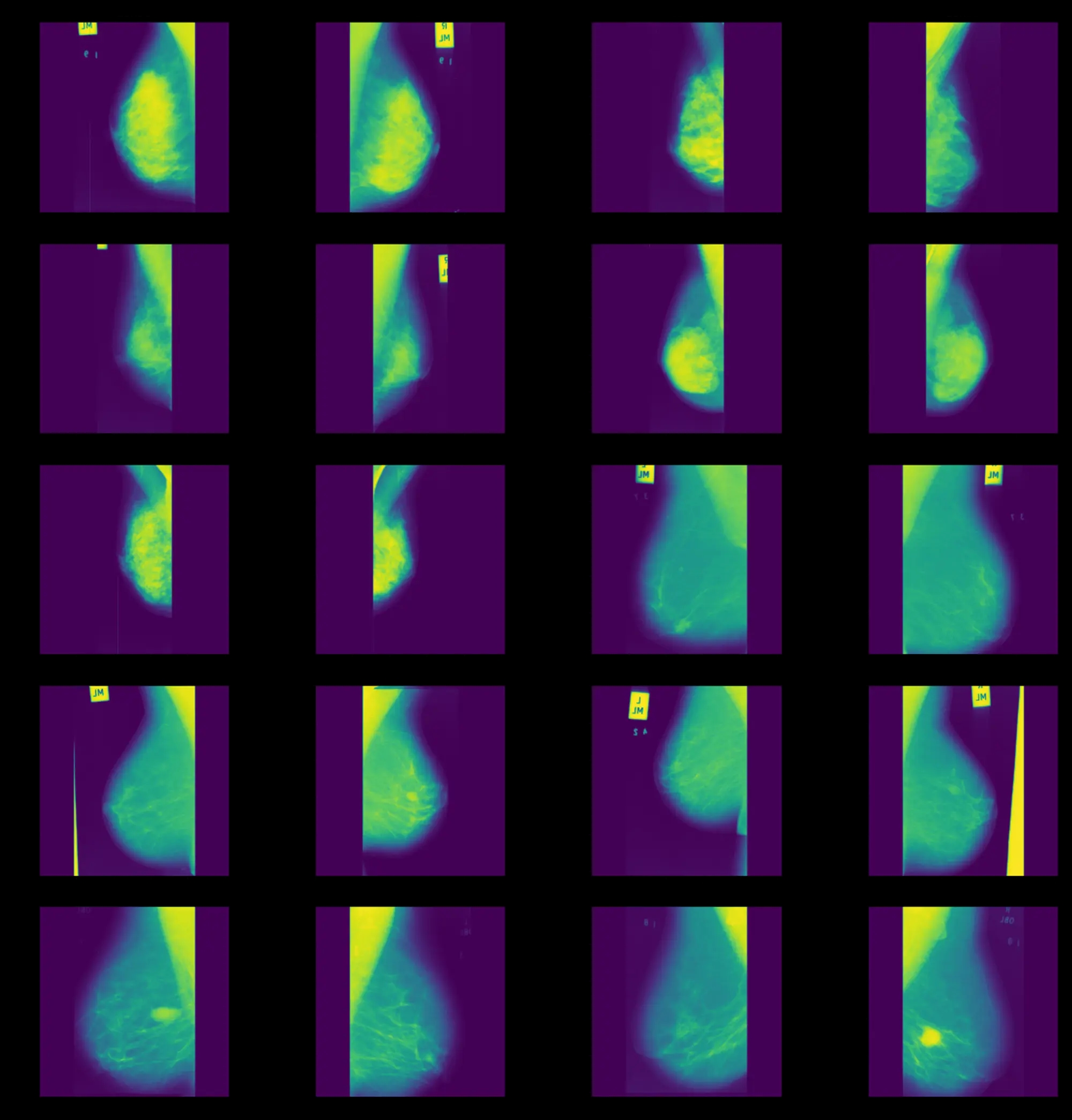 Breast Cancer Detection project image